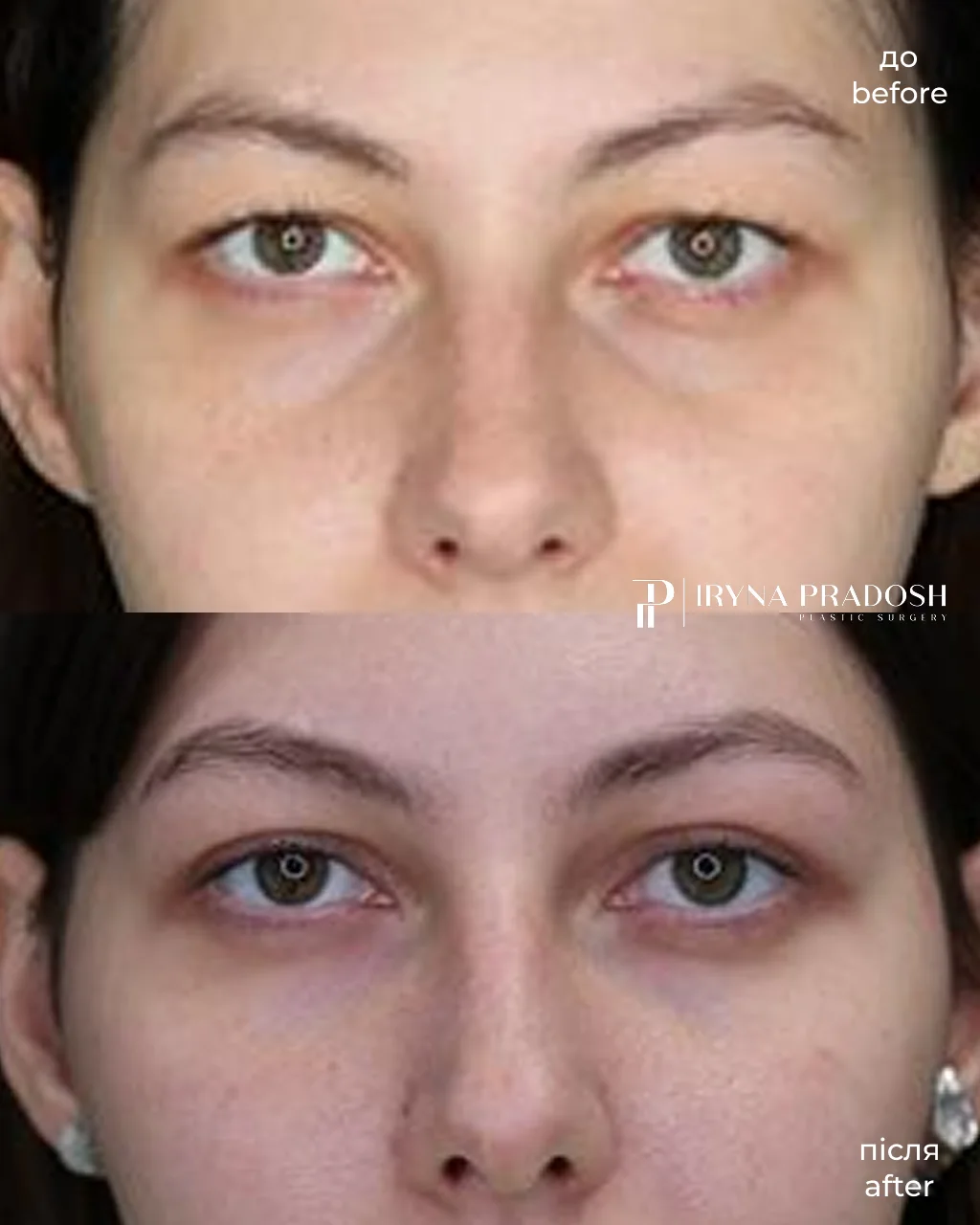 Upper Blepharoplasty: Correcting Hooded Eyelids and Rejuvenating the Look — до і після операції, view 1