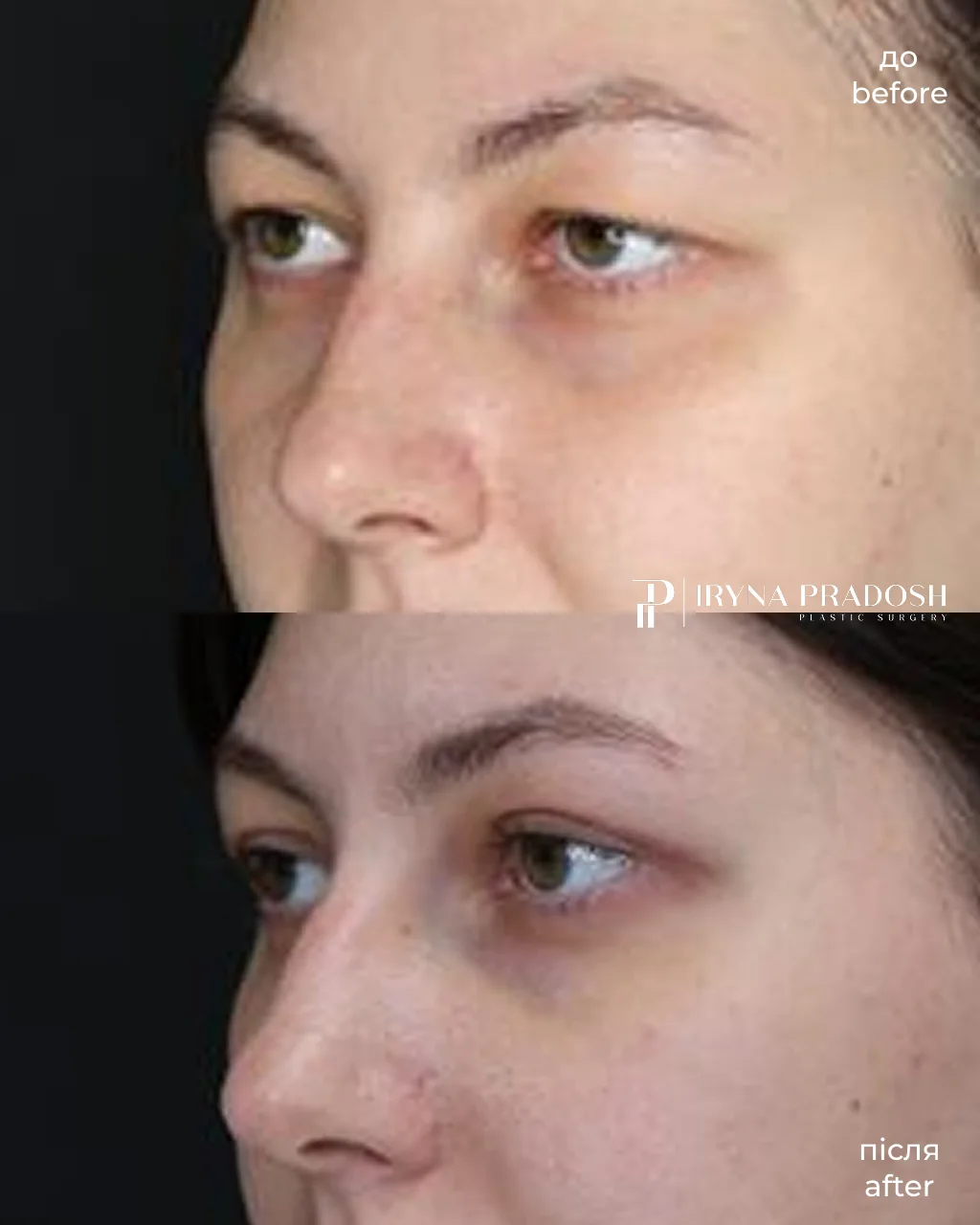 Upper Blepharoplasty: Correcting Hooded Eyelids and Rejuvenating the Look — до і після операції, view 2