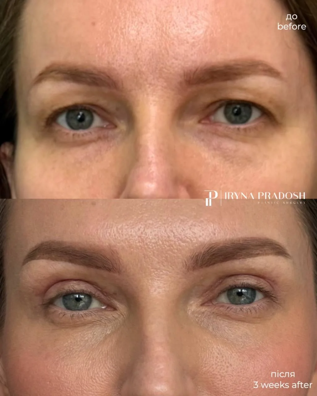 Aesthetic Upper Eyelid Correction and a Well-Defined Contour — до і після операції