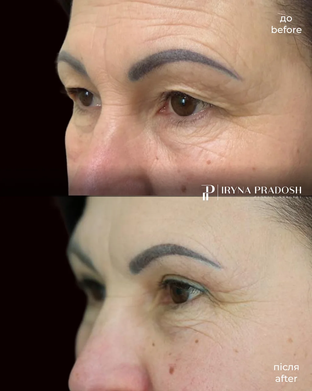Upper Eyelid Surgery: Removing Hooded Skin and Restoring a Fresh Look — до і після операції, view 2