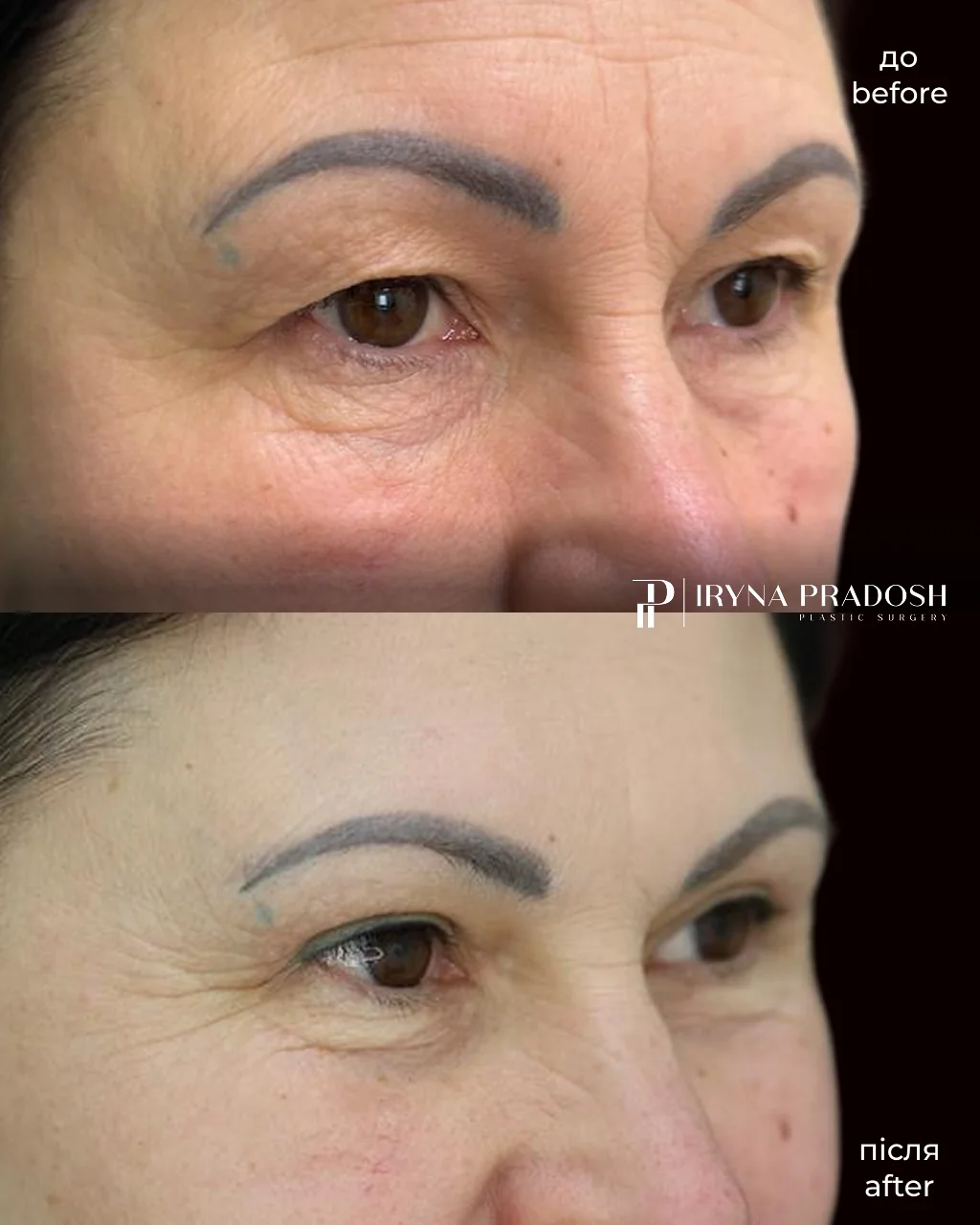 Upper Eyelid Surgery: Removing Hooded Skin and Restoring a Fresh Look — до і після операції, view 3