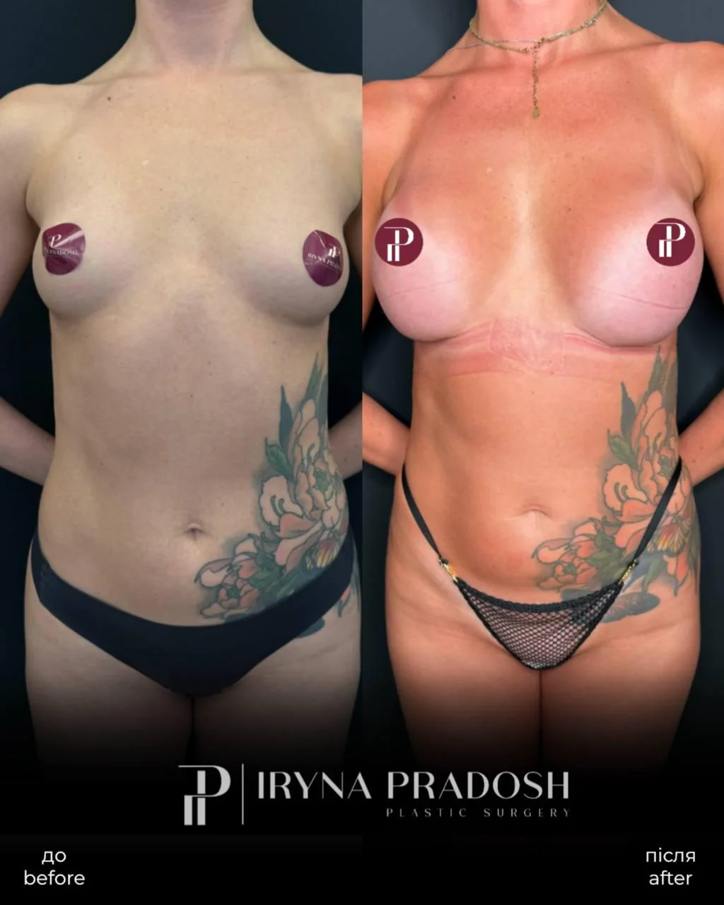 Breast Augmentation and Shape Harmonization with Implants — до і після операції