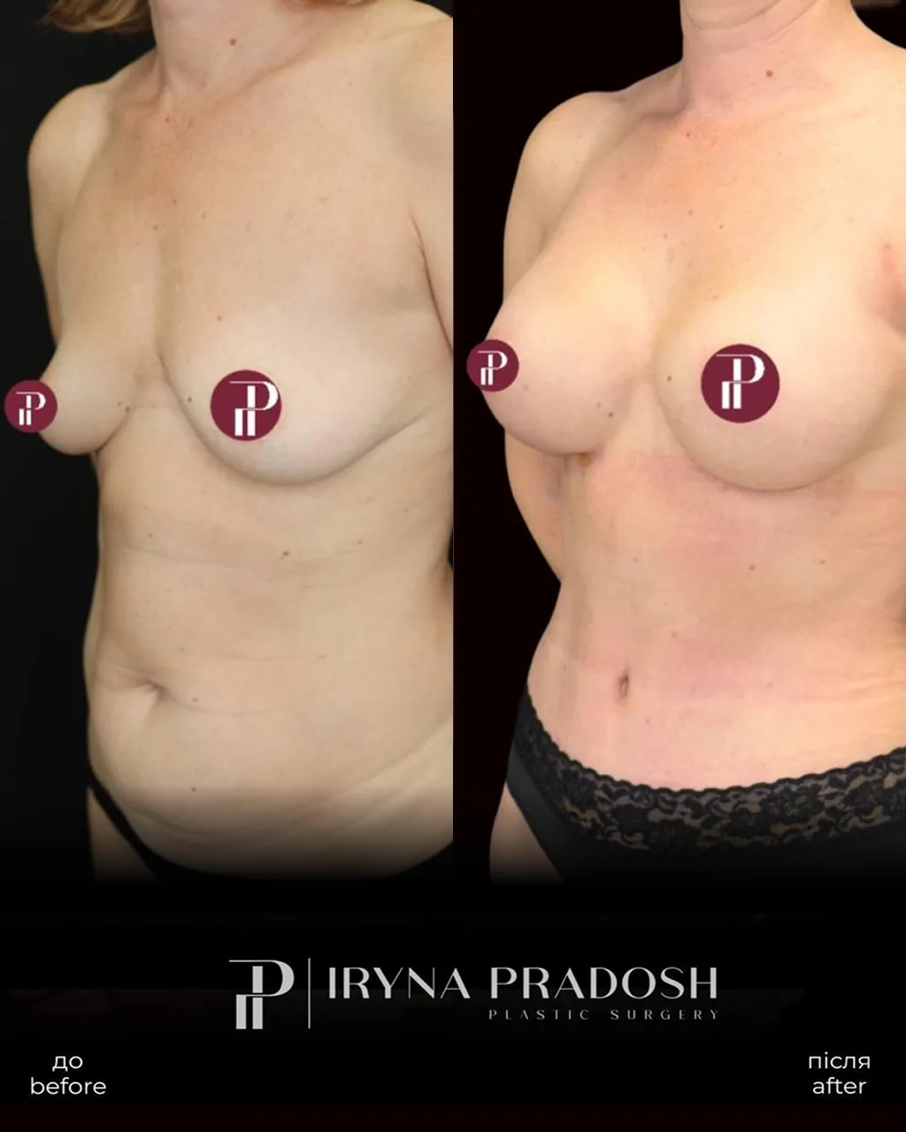 Complete Body Renewal: Breast Lift with Implants and Tummy Tuck — до і після операції