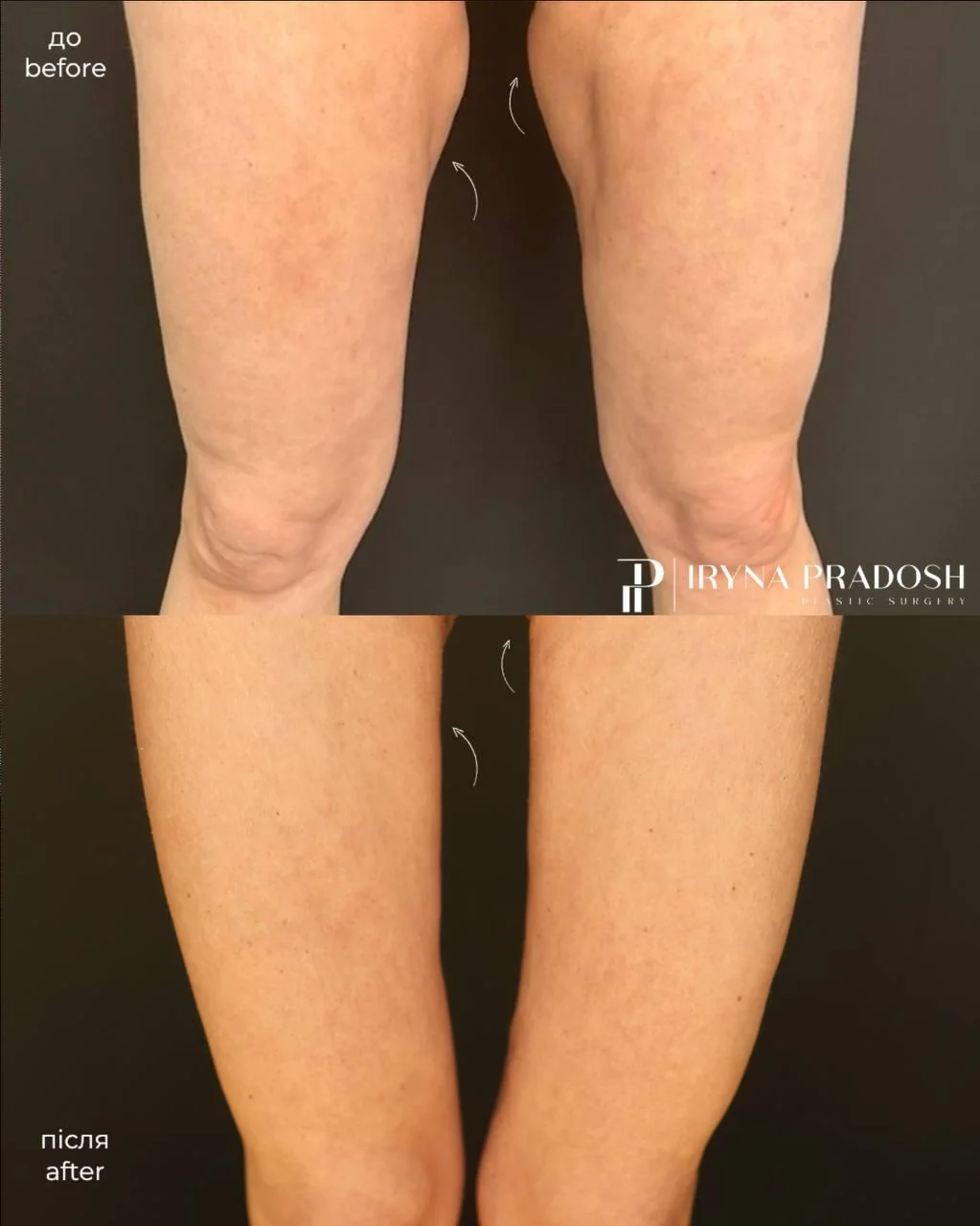 Femoroplasty: Tightening Loose Skin and Restoring Harmonious Leg Contours — до і після операції