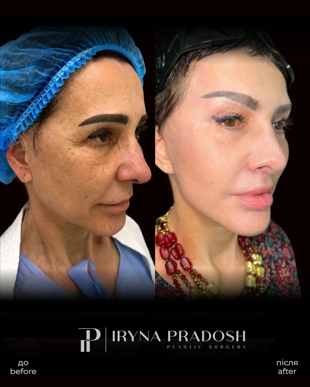 Deep Facelift: Lifted Tissues and a Refined Profile — до і після операції, view 1