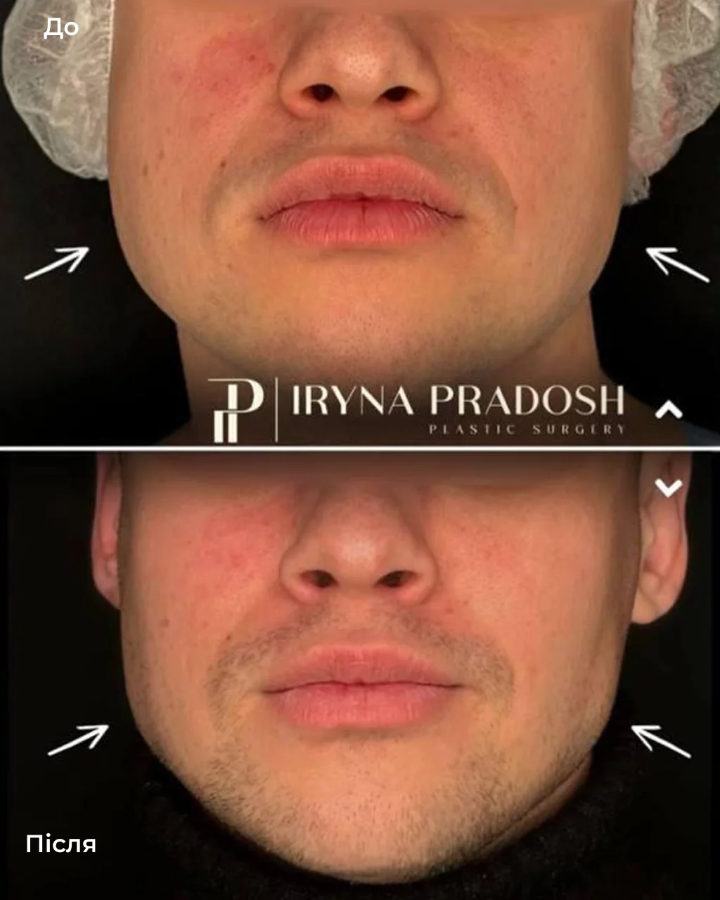 Midface Contouring: Defining the Cheekbones and Reducing Cheek Volume — до і після операції, view 1