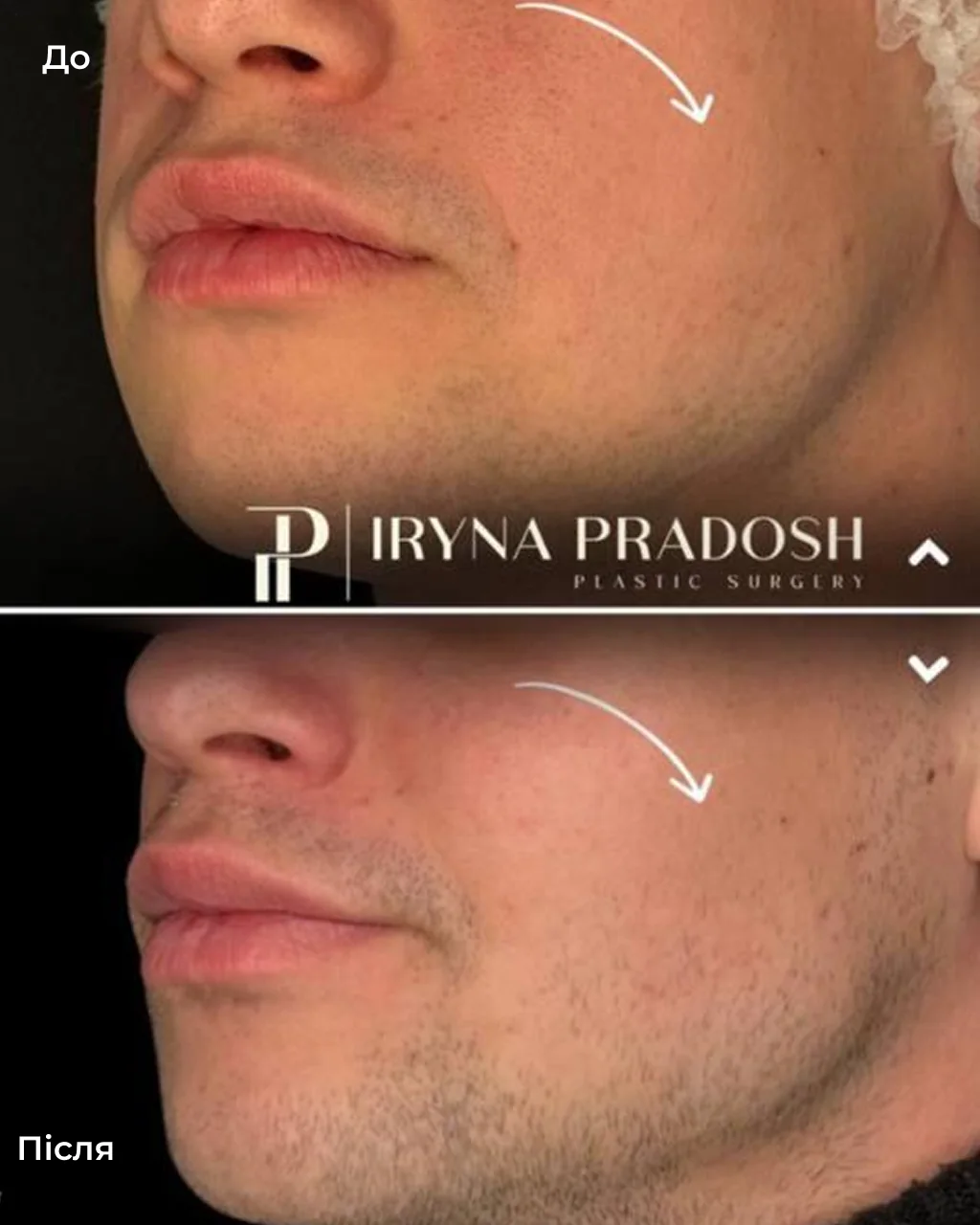 Midface Contouring: Defining the Cheekbones and Reducing Cheek Volume — до і після операції, view 3