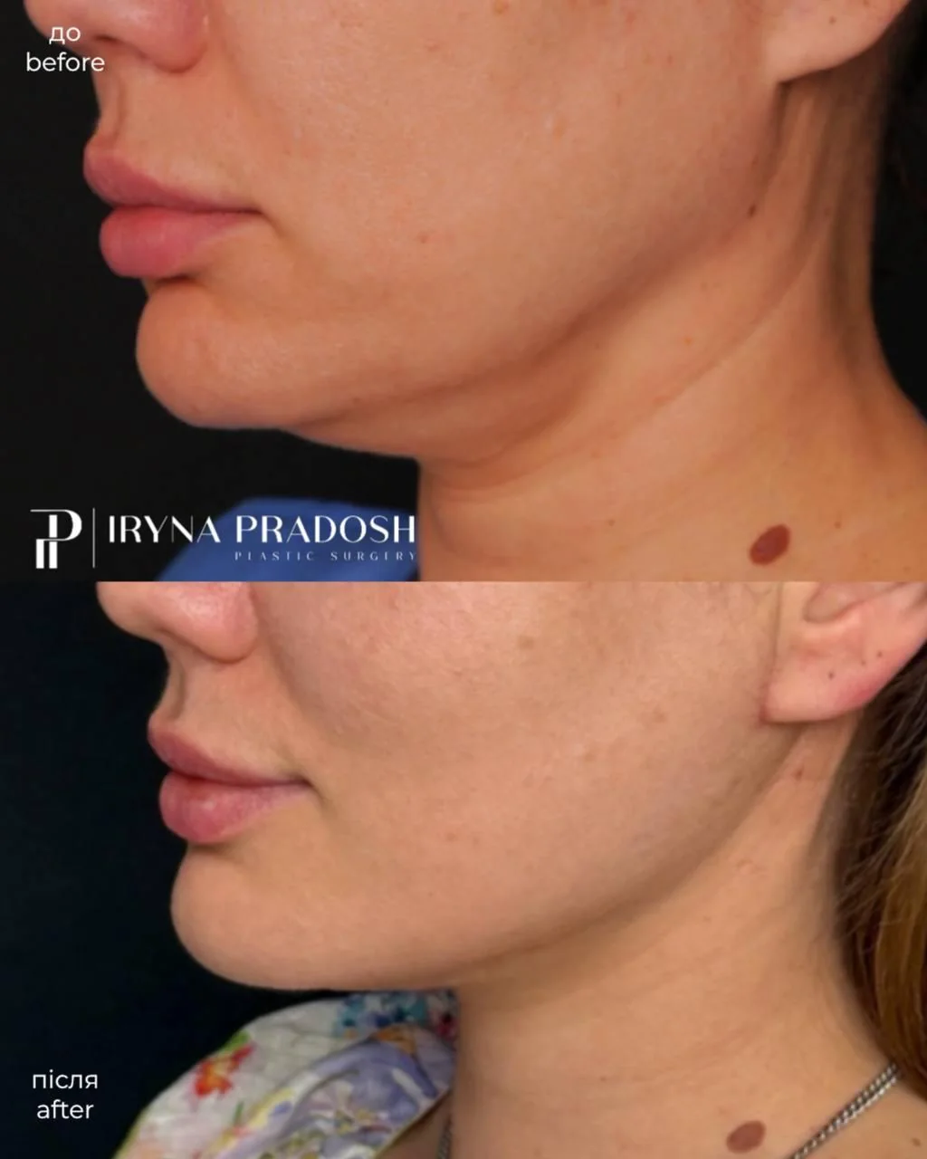 Neck Lift (Platysmaplasty) and Chin Liposuction — до і після операції, view 3