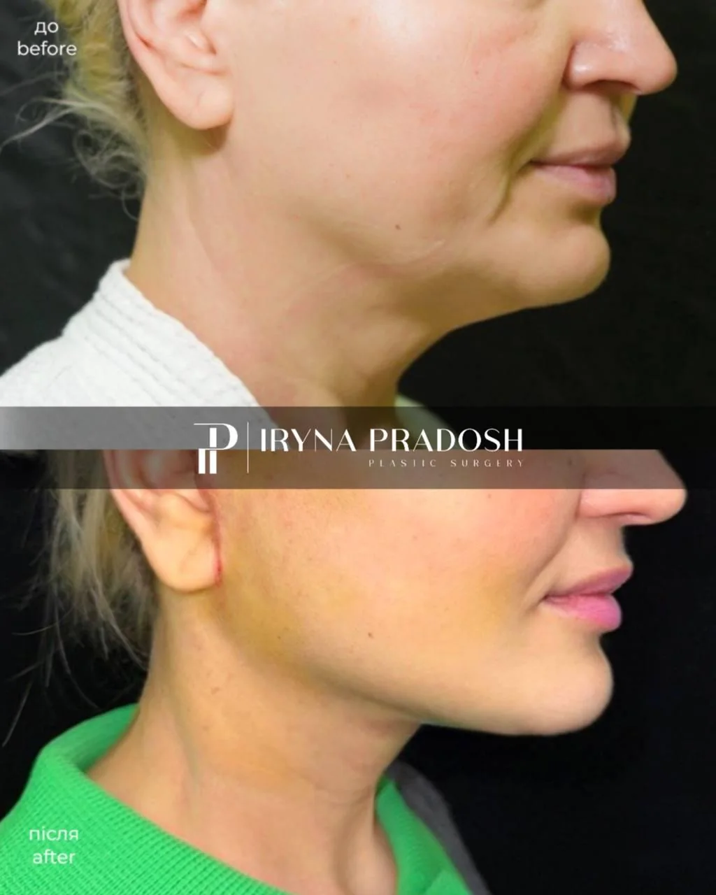Comprehensive Lower Facelift and Platysmaplasty — до і після операції