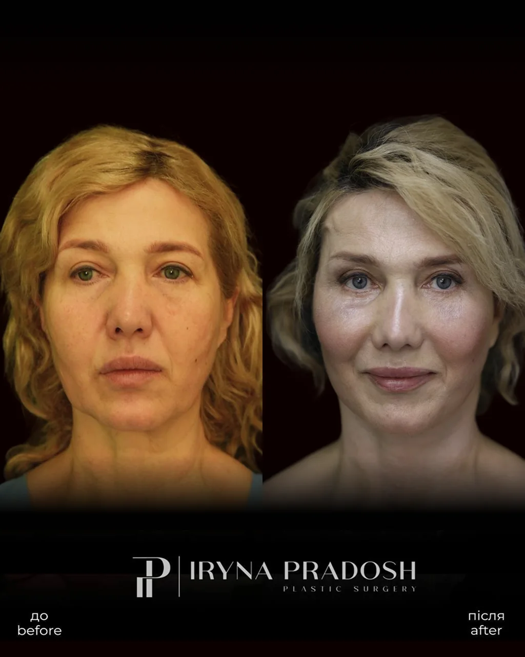 Facelift and Neck Lift: Renewed Contours and a Natural Rejuvenating Effect — до і після операції, view 1
