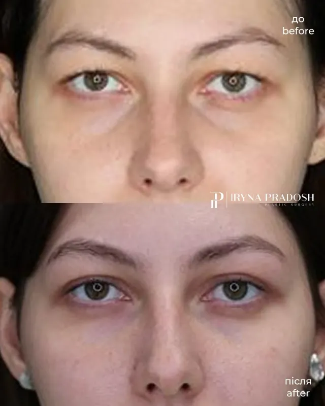 Upper Blepharoplasty: Correcting Hooded Eyelids and Rejuvenating the Look — до і після операції, view 1