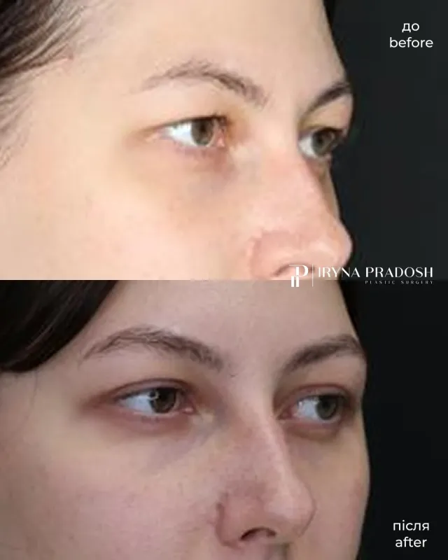 Upper Blepharoplasty: Correcting Hooded Eyelids and Rejuvenating the Look — до і після операції, view 3