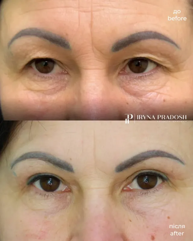 Upper Eyelid Surgery: Removing Hooded Skin and Restoring a Fresh Look — до і після операції, view 1