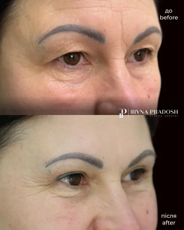 Upper Eyelid Surgery: Removing Hooded Skin and Restoring a Fresh Look — до і після операції, view 3