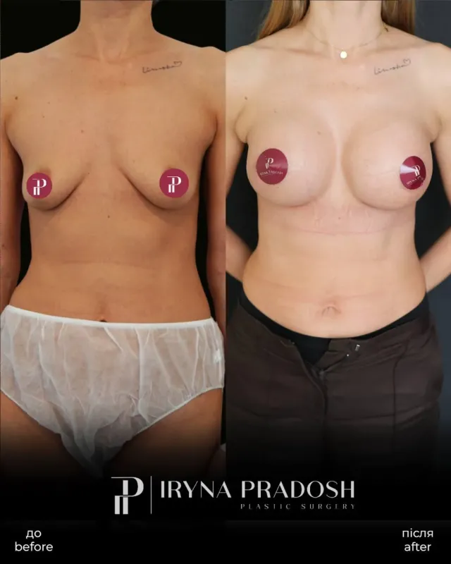 Augmentation Mammoplasty: Correcting Volume and Symmetry — до і після операції