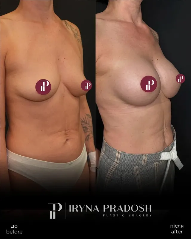 Breast Enlargement: Refined Bust and Décolleté Contouring — до і після операції