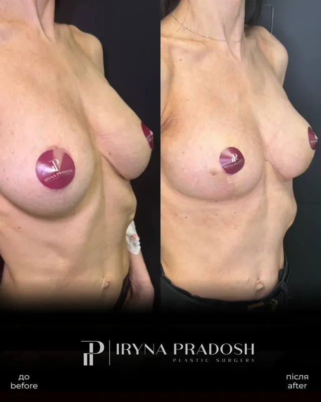 Revision of Previous Breast Surgery: Correcting Asymmetry and Harmonizing Contours — до і після операції