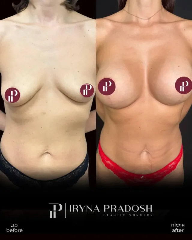 Restoring Shape and Volume: Anchor Mastopexy with Implant Selection — до і після операції, view 1