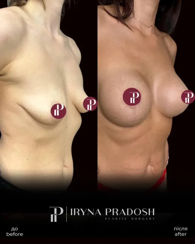 Restoring Shape and Volume: Anchor Mastopexy with Implant Selection — до і після операції, view 2